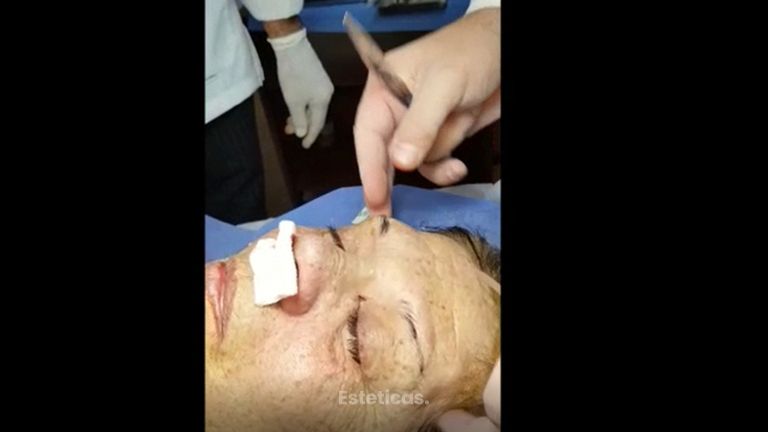  Cirugía de Rinolook - técnica de hilos nasales y técnica cola de cejas