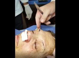  Cirugía de Rinolook - técnica de hilos nasales y técnica cola de cejas