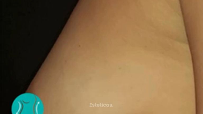 Aumento mamas - Dr. Walter Gabriel Huck - Centro Médico Alvear