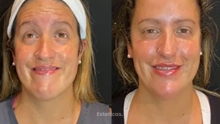 Botox - Antes y Después - Dra. Romina Neira