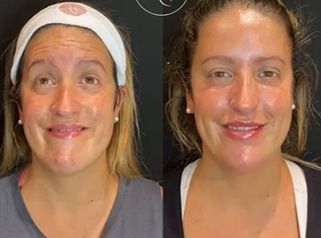 Botox - Antes y Después - Dra. Romina Neira