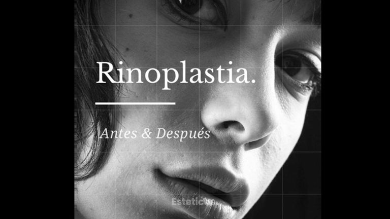 Rinoplastia - Dr. Héctor Martínez Gomez
