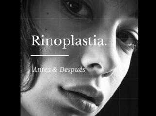 Rinoplastia - Dr. Héctor Martínez Gomez