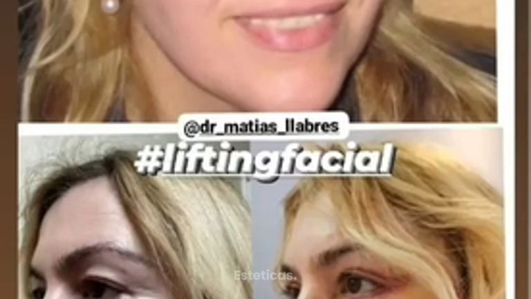 Lifting Facial - Dr. Matias Llabres