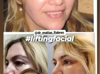 Lifting Facial - Dr. Matias Llabres