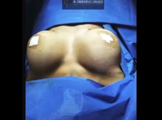 Aumento de mamas - Dr. Fabian Vargas Carrasco