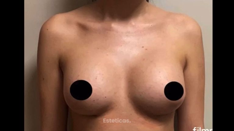 Aumento de mamas - Dr. Fabian Vargas Carrasco