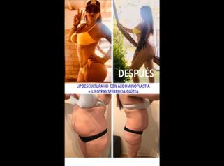 Lipoescultura HD + abdominoplastia + lipotransferencia glútea