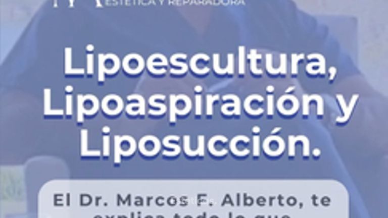 Lipoescultura - Dr. Marcos F. Alberto