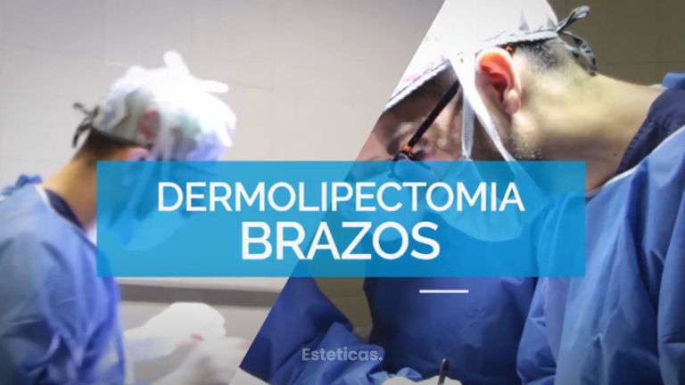Dermolipectomia de Brazos - Dr. Mateo Castro Béduchaud