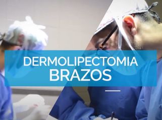 Dermolipectomia de Brazos - Dr. Mateo Castro Béduchaud