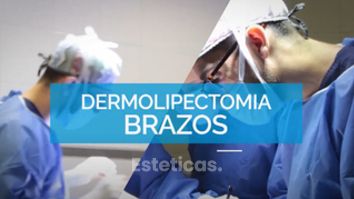 Dermolipectomia de Brazos - Dr. Mateo Castro Béduchaud