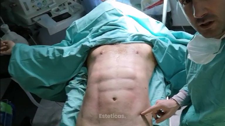 Lipoaspiración