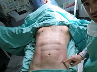 Lipoaspiración