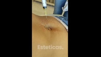 Mesoterapia