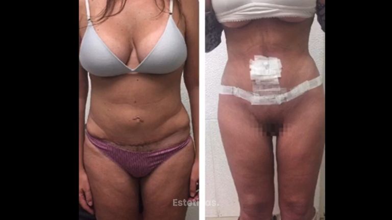 Abdominoplastia - Dra. Georgina Vidal Bianchi