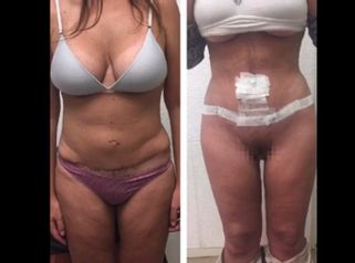 Abdominoplastia - Dra. Georgina Vidal Bianchi