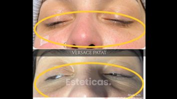 Eliminación de las ojeras
