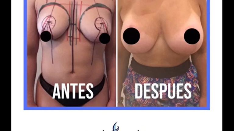 Aumento de mamas
