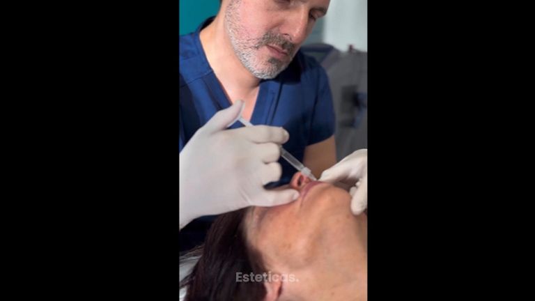 Rellenos faciales - Dr. Cristian Gänsslen