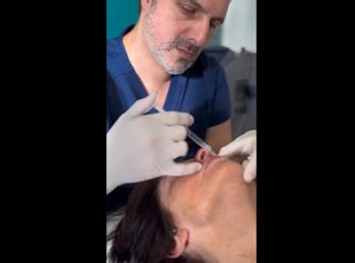 Rellenos faciales - Dr. Cristian Gänsslen