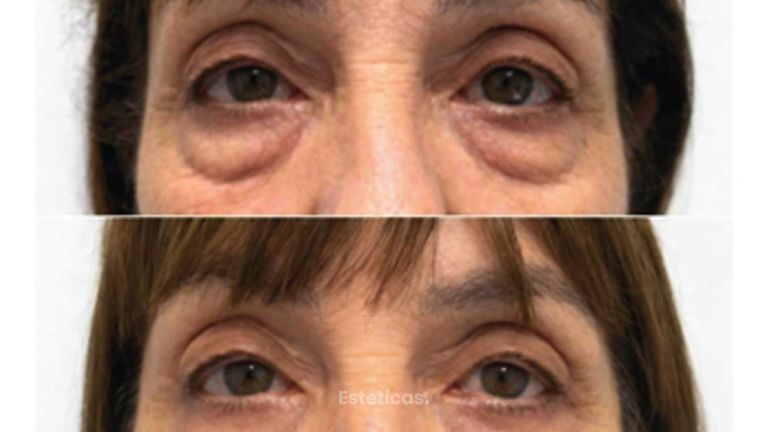 Blefaroplastia - Dr. Ariel Ignacio García
