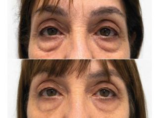 Blefaroplastia - Dr. Ariel Ignacio García