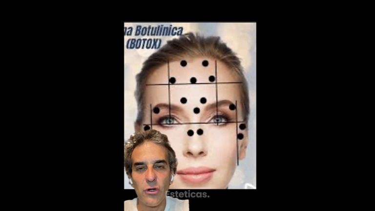 Botox - Dr. Diego Cunille