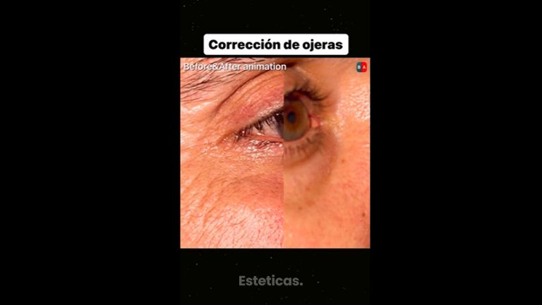 Eliminar ojeras - Dr. Diego Cunille