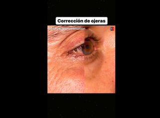 Eliminar ojeras - Dr. Diego Cunille