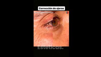 Eliminar ojeras - Dr. Diego Cunille