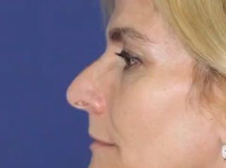 Rinoplastia - Dr. Gabriel Mirave