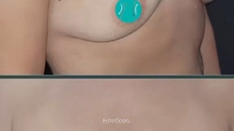 Aumento mamario - Dr. Walter Gabriel Huck - Centro Médico Alvear