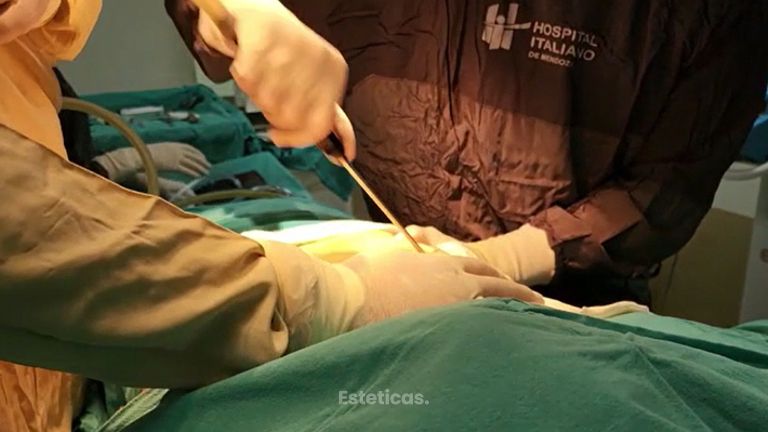 Liposucción - Dr. Javier Nicolía - Centro Médico Palmares