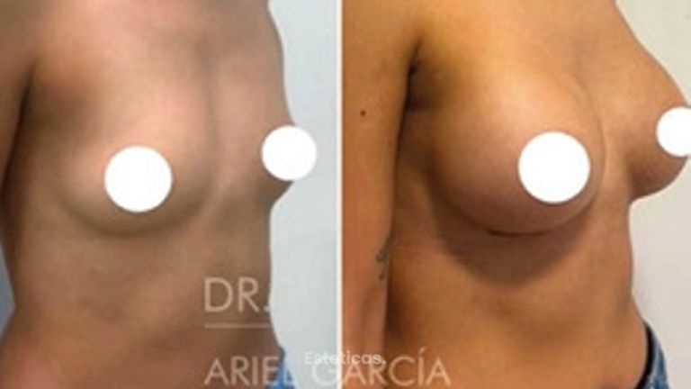 Aumento Mamas - Dr. Ariel Ignacio García