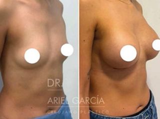 Aumento Mamas - Dr. Ariel Ignacio García