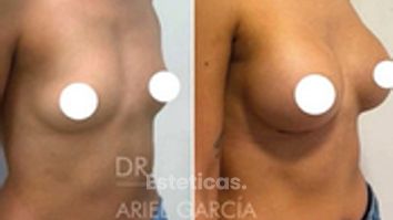 Aumento Mamas - Dr. Ariel Ignacio García