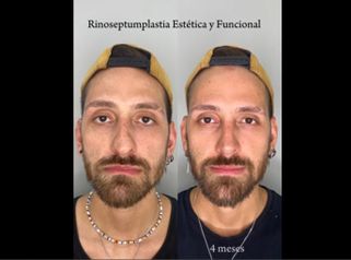 Rinoplastia - Dr. Santiago Rosales Castiglione