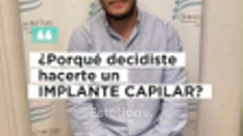Implante capilar Pelo por Pelo - Dr. Damian Galeazzo y Equipo