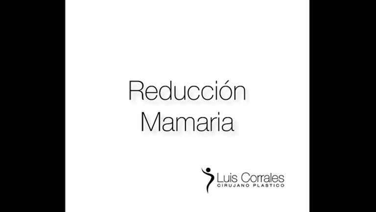 Reducción de mamas - Dr Luis Corrales
