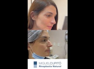 Rinoplastia - Dr. Miguel Ángel Cupito