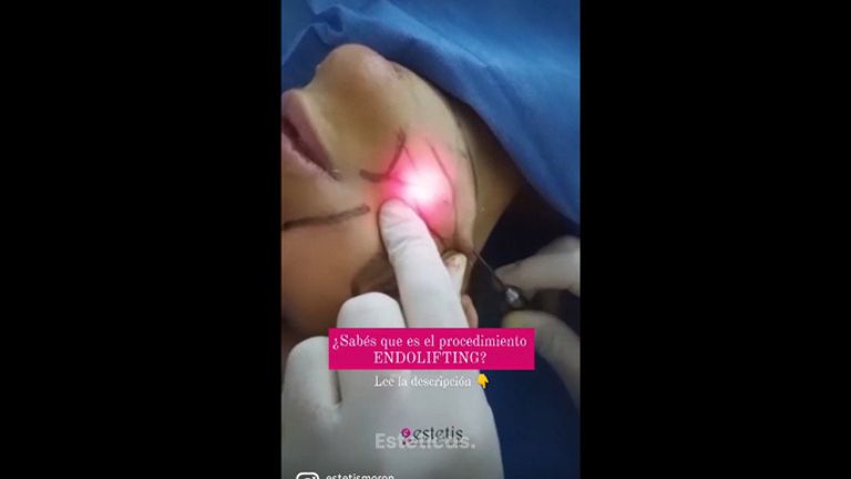 Endolifting - Estetis