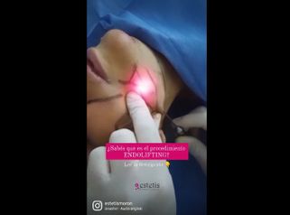 Endolifting - Estetis