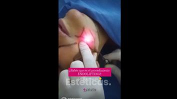 Endolifting - Estetis