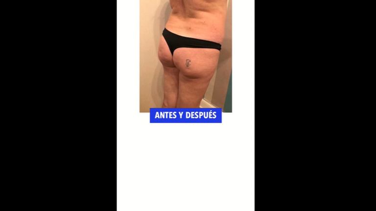 Lipotransferencia glútea