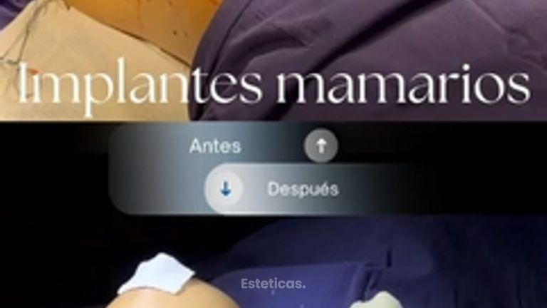 Aumento mamarios