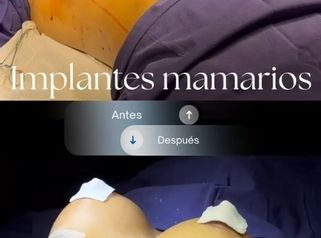 Aumento mamarios