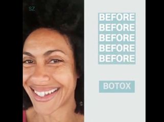 Botox - Dr. Zuccardi Santiago