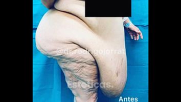 Abdominoplastia 