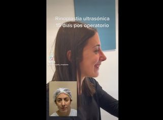 Rinoplastia - Dr. Miguel Ángel Cupito